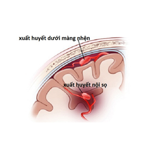 Các bệnh về não